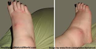 natural remes for swollen ankles