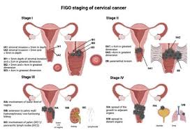 individualized treatment of cervical cancer