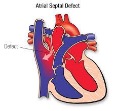This results in symptoms of breathlessness, rapid breathing or heart beat, heavy heart beats and heart failure and ultimately early death if untreated. Atrial Septal Defect Asd American Heart Association