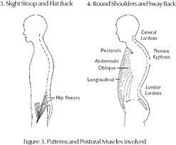 Stiff Man Syndrome (a.k.a. Moersch-Woltmann Syndrome) and Lumbar Lordosis