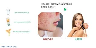 how to hide acne scars without makeup