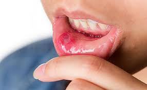 treating canker and cold sores