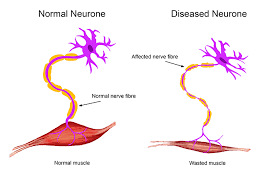 motor neurone disease is the breakdown