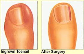 ingrown toenail correction st