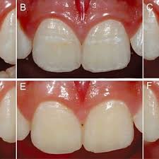 Dental fluorosis is a condition that affects the teeth caused by excessive intake of flouride. Case 1 Mild To Moderate Fluorosis And Hypoplasia Related To Traumatic Download Scientific Diagram