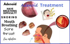 adenoids homeopathy treatment chennai