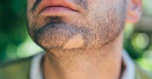 bald patch in beard causes and treatments