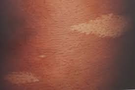 white spots on skin 9 causes what
