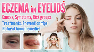 eczema on eyelids causes symptoms
