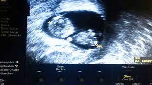 Mal baby im ultraschall justus sorgt sich! 10 Ssw 10 Schwangerschaftswoche Grosse Entwicklung 9monate De
