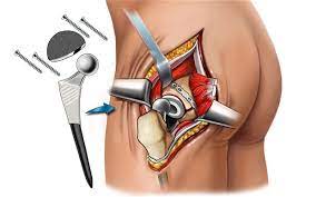 hip replacement surgery types