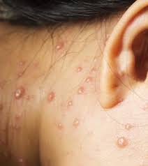 7 Effective Home Remedies To Treat Chicken Pox In Teens