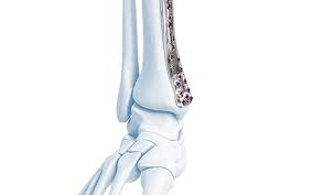 Leg Fracture Surgical Placement Reflection