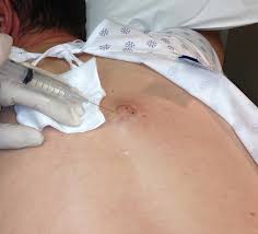 abscess incision and drainage a