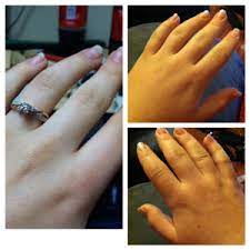 hand swelling february 2016 es