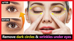 remove dark circles under eyes