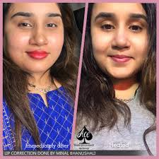best lip correction treatment in mumbai