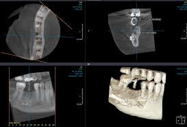 dental cone beam ct a review