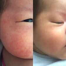 baby eczema and rashes best natural