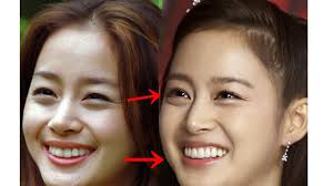 kim tae hee plastic surgery before and