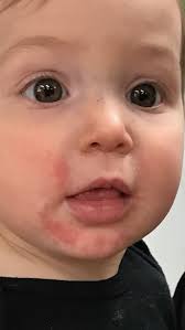 is your child allergic to strawberries
