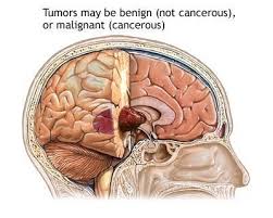 Image result for brain tumor symptoms