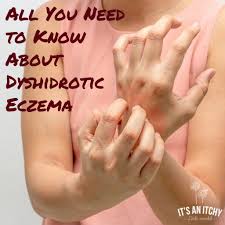 what is dyshidrotic eczema it s an