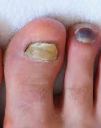 green under fingernail or toenail