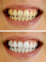 best at home teeth whitening methods