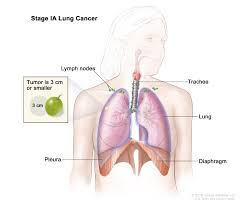 Non Small Cell Lung Cancer Treatment Pdq Health