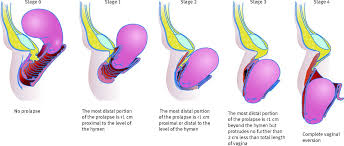pelvic organ prolapse the bmj