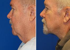 Image result for turkey neck under the chin
