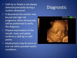 ppt cleft lip or cleft palate