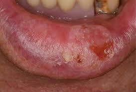 symptoms of lip cancer in patients