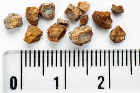 The Kidney Stone Diet Five Foods To Prevent Them