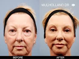 toronto facelift surgeons deep plane