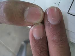 understanding nail diseases and