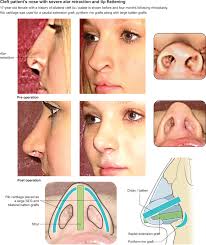 rhinoplasty in cleft lip and palate