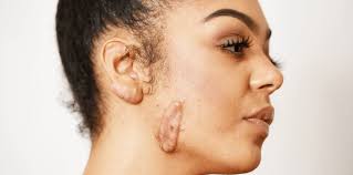 how to get rid of keloids skincare