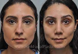 rhinoplasty for a crooked nose nose