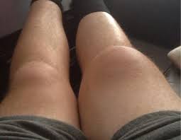 post surgical knee swelling lake