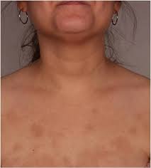pigmentation the science of the spots