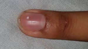 what causes white spots on fingernails