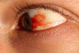 blood in eyes reasons symptoms and