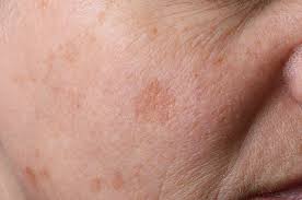 brown spots tucson hyperpigmentation