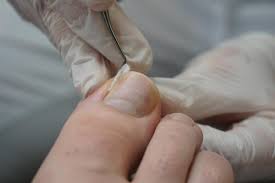 when an ingrown toenail requires help