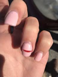 broken real and acrylic nail january