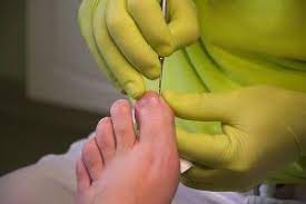 toenail fungus treatment in shillington