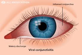 types of conjunctivitis pink eye