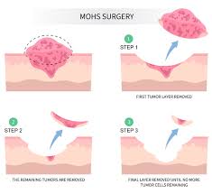 mohs surgery works conway cal center